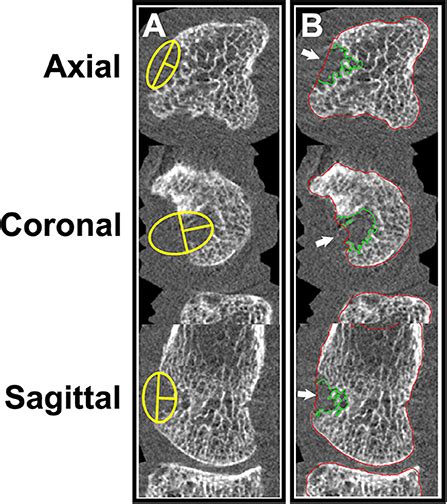 Frontiers High Resolution Peripheral Quantitative Computed Tomography