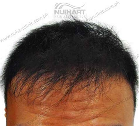 Nuhart3 Nuhart Hair Restoration Philippines