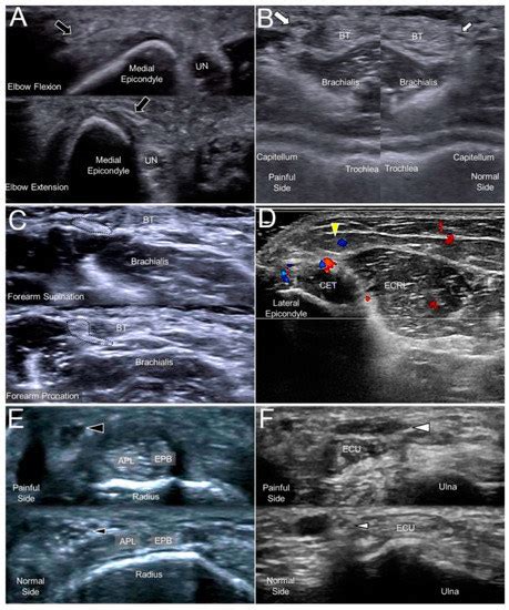 Jcm Free Full Text Ultrasound Imaging For The Cutaneous Nerves Of The Extremities And