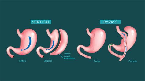 Cliadi Especialsitas Em Cirurgia Bari Trica Por V Deo