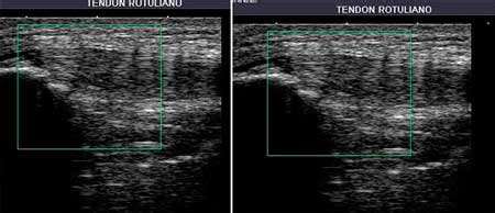 Tendinopat A Rotuliana O Rodilla Del Saltador Dr Villanueva