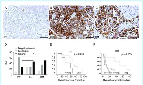 Alcam Expression In Primary Tumor And Metastatic Tissue From Nsclc