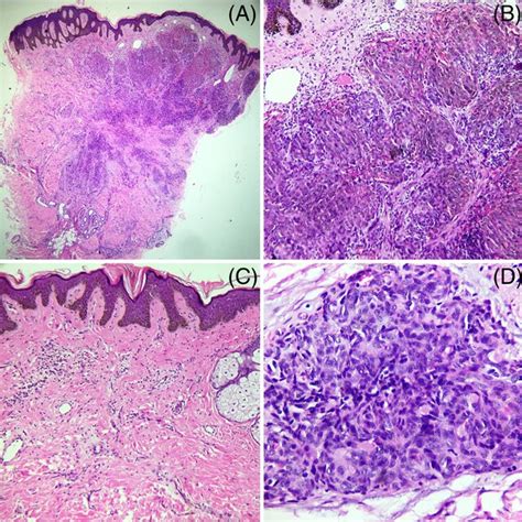 A Multiple Arcuate And Annular Hyperpigmented Plaques With Central