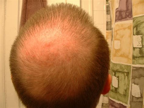 Hair Transplant Results After 2 Months