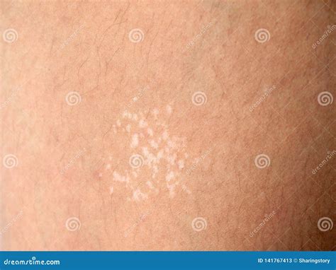 Background Of The Human Skin Stock Image Image Of Hairs Peel 141767413