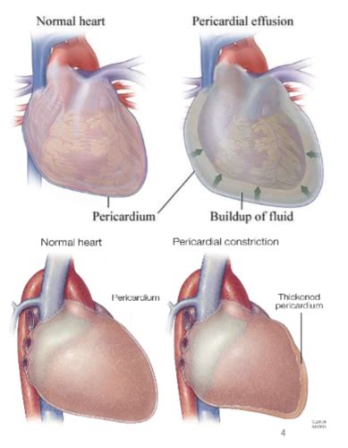 Patho U L Disorders Of Cardiac Function Flashcards Quizlet