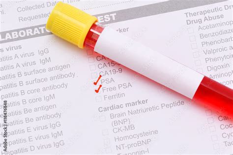 Blood Sample For PSA Test Prostate Cancer Diagnosis Stock Photo