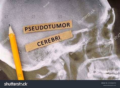 Pseudotumor Cerebri: Over 6 Royalty-Free Licensable Stock Photos ...