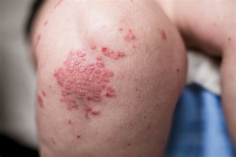 รูปภาพneurodermatitis เลือกดูภาพถ่ายสต็อก เวกเตอร์ และวิดีโอ496