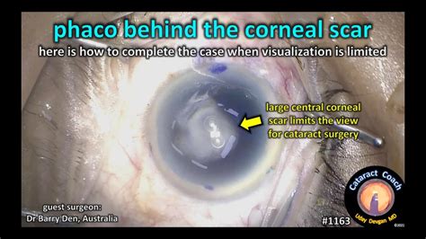 Cataractcoach 1163 Cataract Surgery Behind A Corneal Scar Youtube