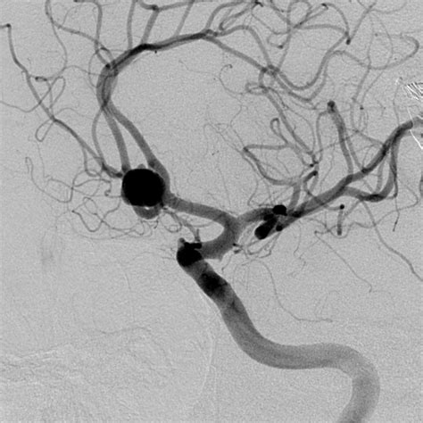 Ruptured Anterior Communicating Artery Aneurysm Image