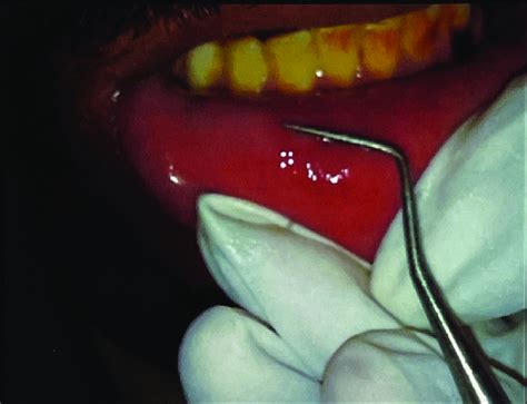 Measurement Of Size Of Ulcer Download Scientific Diagram