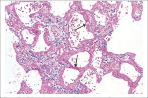 Lung Path Flashcards Quizlet