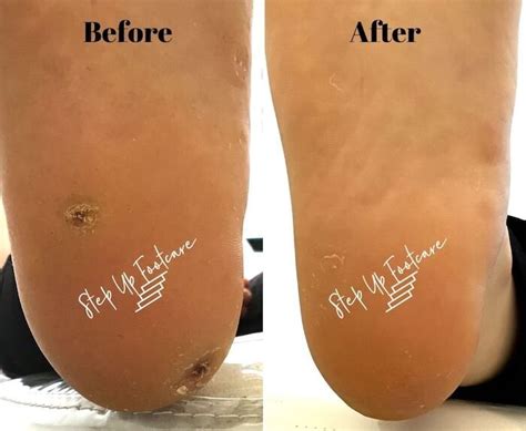 Plantar Wart Treatment Podiatrist Nyc Downtown Step Up Footcare