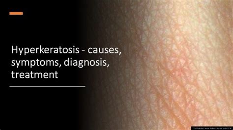 Hyperkeratosis - causes, symptoms, diagnosis, treatment - Healthhavoc