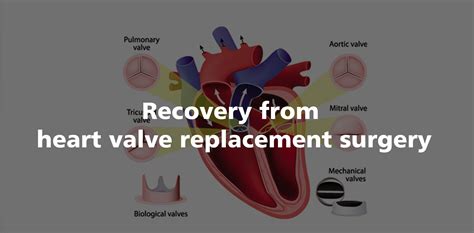 What Is Recovery Time For Valve Replacement Surgery at Lucinda Kindler blog