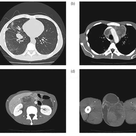 A Multiple Lung Metastases B Mediastinal Lymph Node Metastasis Download Scientific