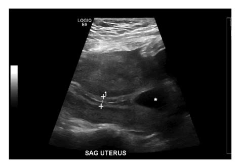 Cesarean Section Scar Ectopic Pregnancy A Sagittal Transabdominal