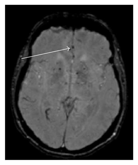 Mri Scan Of Brain Mri Of Brain Axial T2 Weighted Image Showing T2