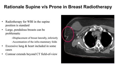 Immobilization And Setup For Prone Breast Radiotherapy A Therapist