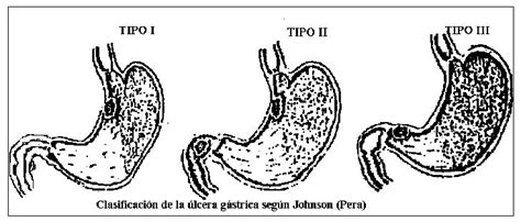 Ulcera Gastroduodenal Ulcera Peptica C Tedra De Cirug A