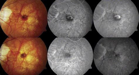 Combined Photodynamic Therapy And Intravitreal Triamcinolone Acetonide