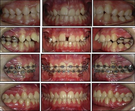 Clinical photographs of orthodontic treatment from pretreatment to ...