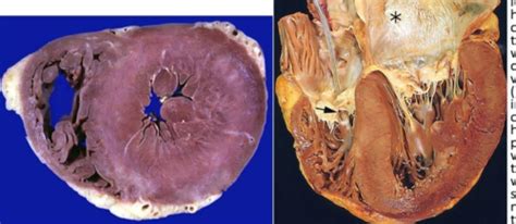 Block Path Sdl Hypertension Flashcards Quizlet