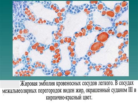 Презентация на тему: 3. Микробная эмболия развивается при