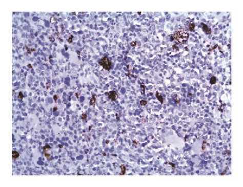 Immunohistochemical Staining Displaying High Numbers Of Cd