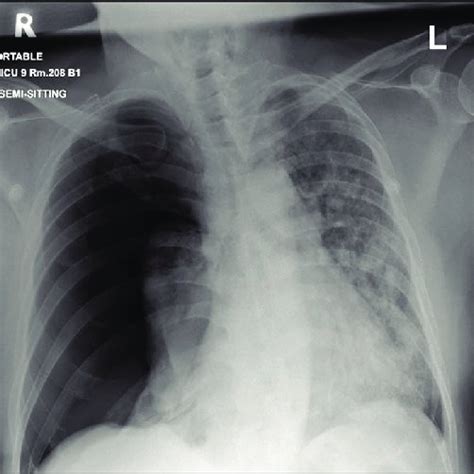 Chest X Ray Posteroanterior View Showing Bilateral Middle And Lower