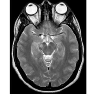 Axial T Weighted Mri Of The Brain Showing Increased T Signal In The