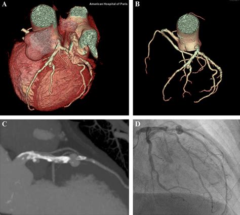 JLE Sang Thrombose Vaisseaux Rôle du scanner coronaire dans le