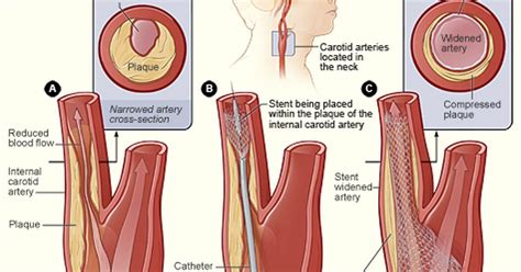 What are the treatments for carotid artery blockage? | eHow UK