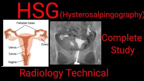 Hsg Hysterosalpingography Complete Study Radiology Technical By