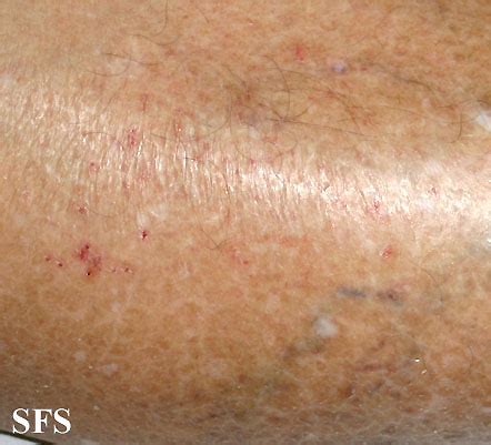 Asteatotic Dermatitis Nc Commons