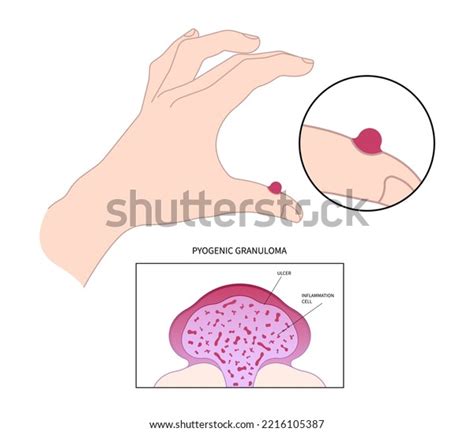 Hand Fingers Pyogenic Granuloma Skin Tumor Stock Vector Royalty Free