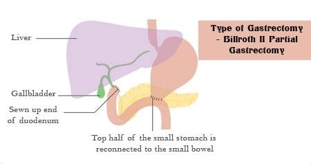 Partial Gastrectomy