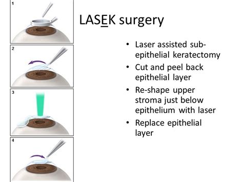 Lasek Procedure