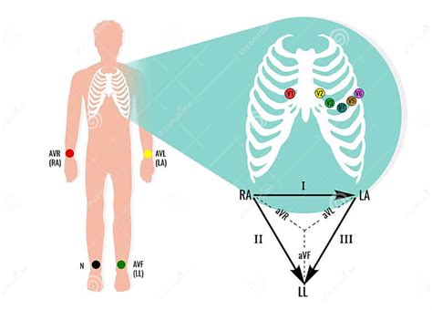 Ecg Electrode Position Illustration With Ecg Limb Leads Useful For Educating Doctors And Nurses