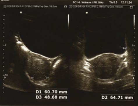 Pelvic Ultrasonography Revealing A Large Intramural Uterine Fibroid