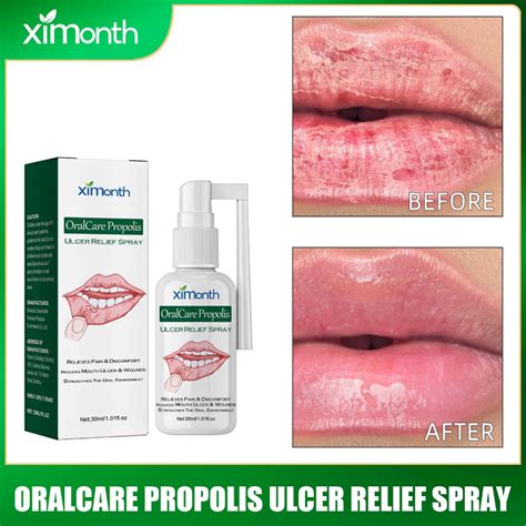 Ximonth Natural Herbal Mouth Ulcer Oral Spray 30ml Swollen Gum Sore