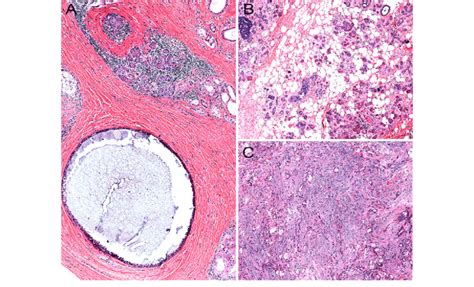 Most Commonly The Stroma In Sclerosing Polycystic Adenosis Is Composed