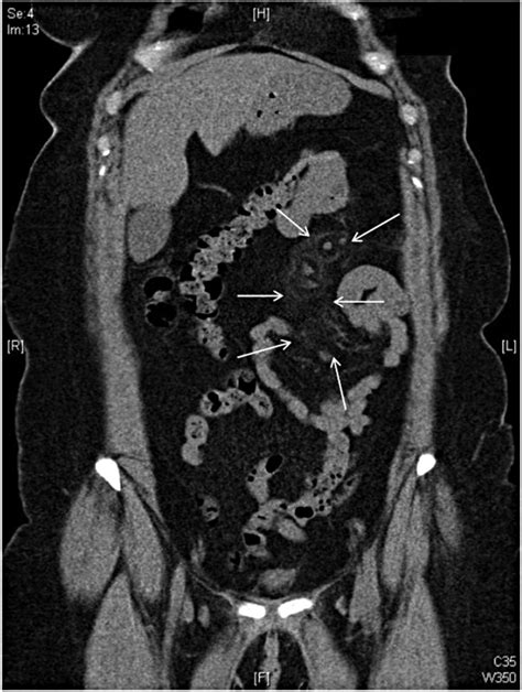 Mesenteric Panniculitis Bmj Case Reports