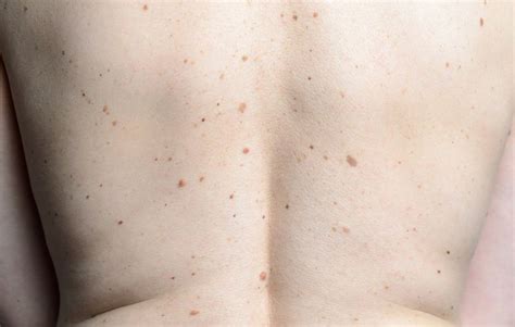 Why Did This Woman Suddenly Develop Thousands of Moles All Over Her Body? | Women's Health