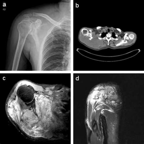 (a), X-ray images show right scapula and that distal clavicle is ...