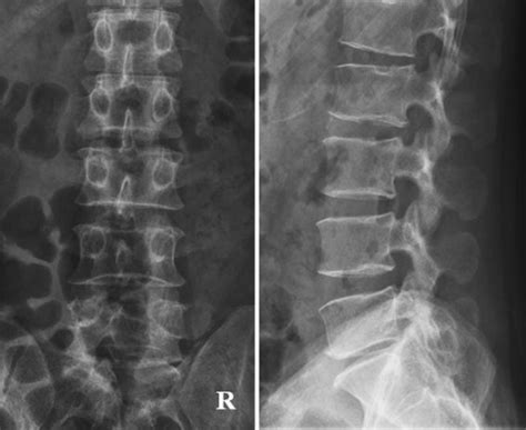 Plain Ap And Lateral Radiographs Of The Lumbar Spine D Open I