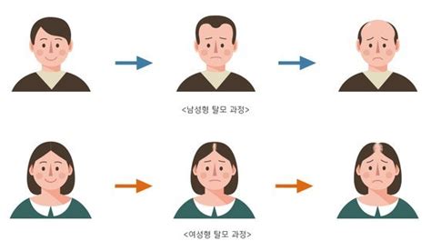 나도 유전성 탈모 적어도 하루 한 번 머리 감고 이것 먹어라 네이트 뉴스