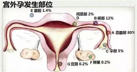 輸卵管為什麼會堵塞，該怎麼治療 宮外孕又是怎麼回事，要做試管嬰兒嗎？ 每日頭條