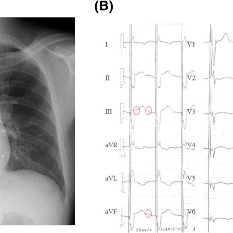 Intracardiac Electrophysiology Fluoroscopic View Of Intracardiac